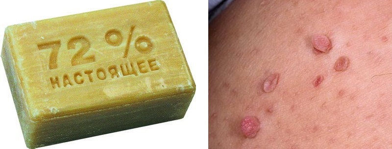Хозяйственное мыло от папиллом, как Хозяйственное мыло от папиллом, как