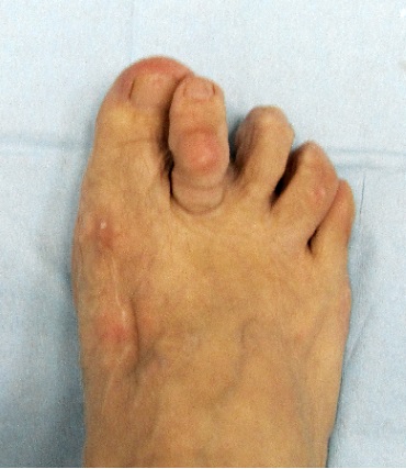 Молоткообразная деформация пальцев стопы