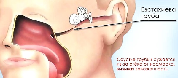 Причины заложенного уха евстахиева труба
