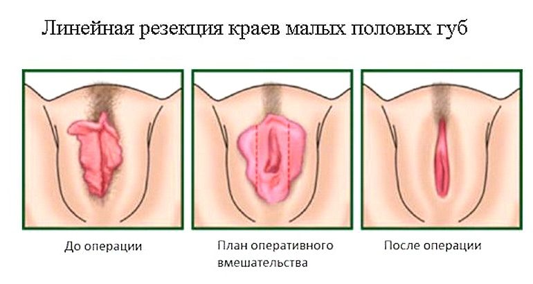 коррекция половых губ
