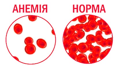 кровь при анемии